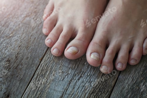 Preview: Close-up of legs with fungus on nails on wooden background.