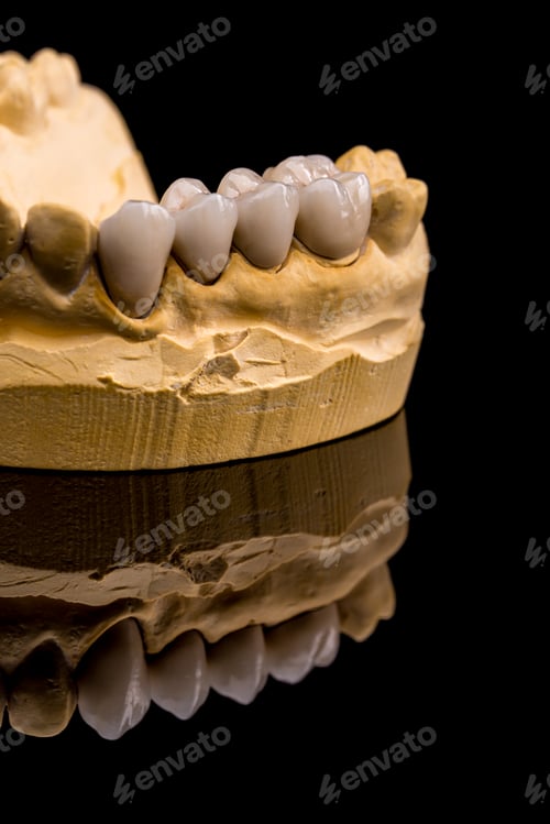 Preview: Dental prosthesis