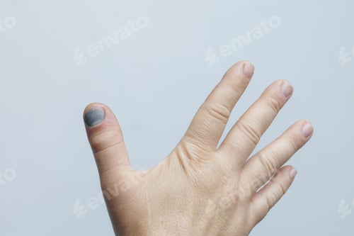 Preview: Subungual hematoma on thumb hand extended medical injury concept