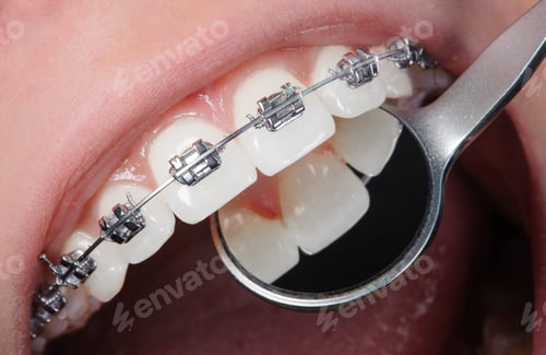 Preview: Close-up dental braces on teeth. Orthodontic Treatment