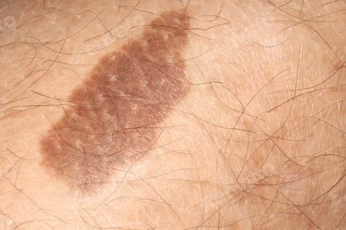 Preview: Macro view of human skin with birthmarks as background