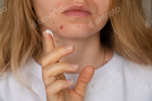 Preview: Unrecognizable woman applies makeup, cream serum cure for acne on face. Close-up acne on woman's