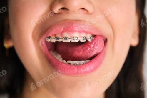 Preview: Unrecognizable teenager mouth with braces stick out her tongue.