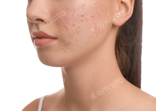 Preview: Teenage girl with acne problem on white background, closeup