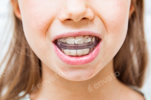 Preview: Child girl wearing orthodontic silicone trainer, close-up.