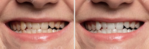 Preview: teeth whitening before and after close-up