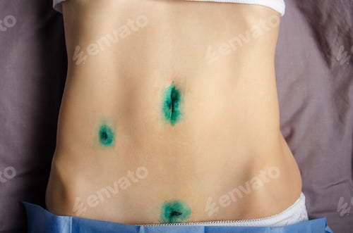 Preview: Middle age caucasian female shows her Healing scars after Laparoscopic Appendix Removal Surgery
