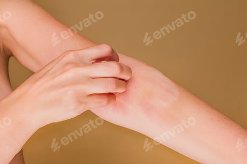 Preview: Woman scratching arm with rash and irritation