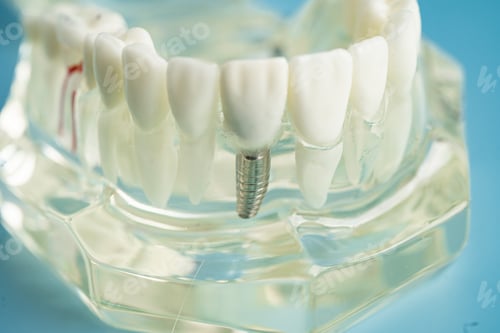 Preview: Dental implant, artificial tooth roots into jaw, root canal of dental treatment