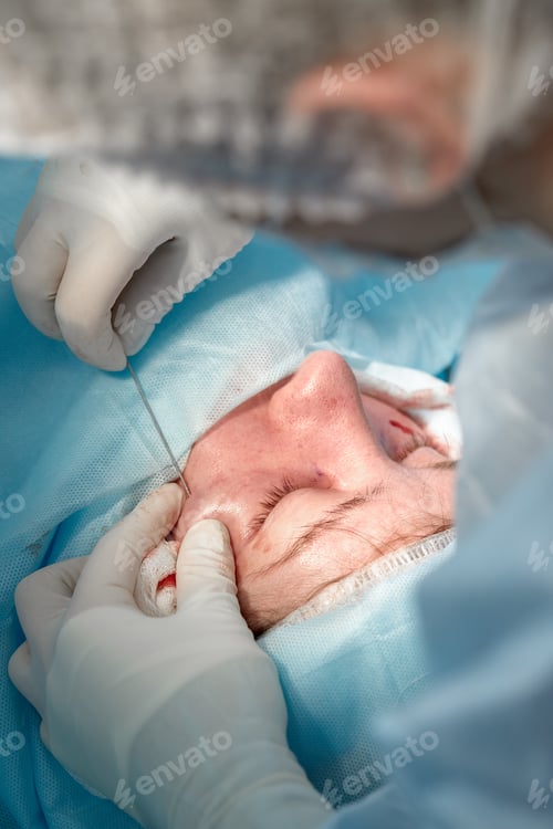Preview: Close up of the face of a patient who is undergoing blepharoplasty. The surgeon cuts the eyelid and
