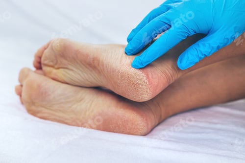 Preview: Female feet dry skin on the heels. Selective focus.