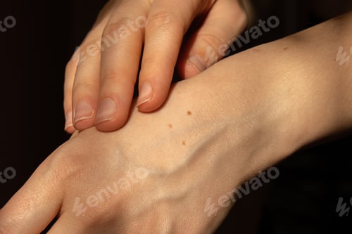 Preview: Birthmarks on skin Close up detail of the bare skin Sun Exposure effect on skin, Health Effects of U