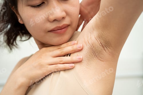 Preview: Asian woman have problem black armpit beauty skin care.