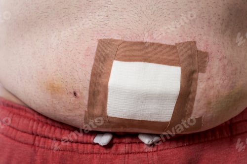 Preview: Patient's wound bandaged with sterile gauze