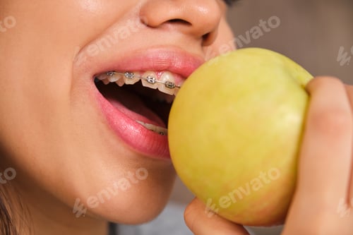 Preview: Close up of teenager mouth with braces eating an apple.