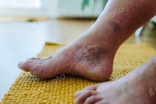 Preview: A close-up shot of man's feet with diabetic foot complications.
