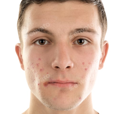 Preview: Young man with acne problem on white background