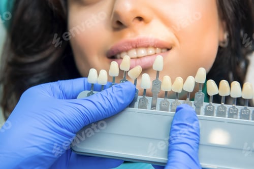 Preview: Tooth color chart