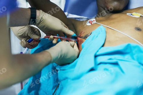 Preview: Close Up of Chest Tube Insertion in Hospital