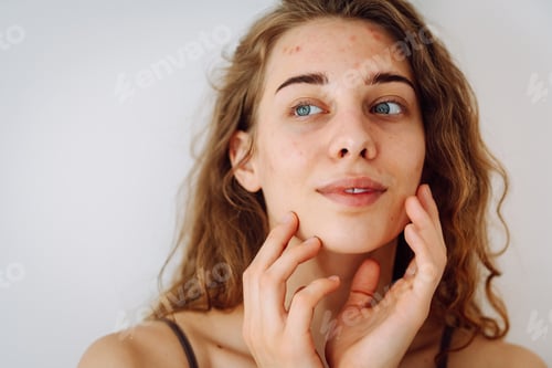 Preview: Portrait of beautiful young woman with inflammations on skin of her face. Medicine and cosmetology.