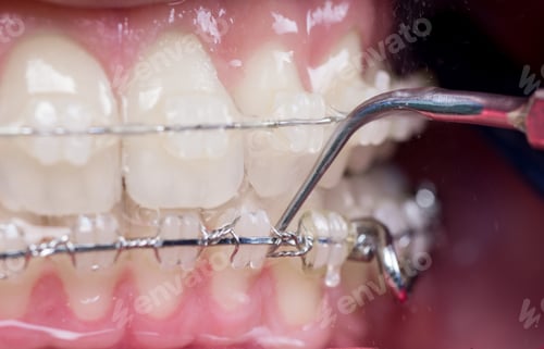 Preview: Dentist checking up teeth with ceramic brackets using probe at the dental office.