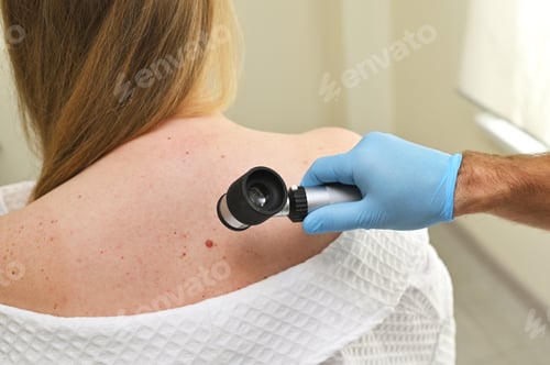 Preview: dermatologist oncologist uses a dermatoscope to examine moles and birthmarks on the patient's body