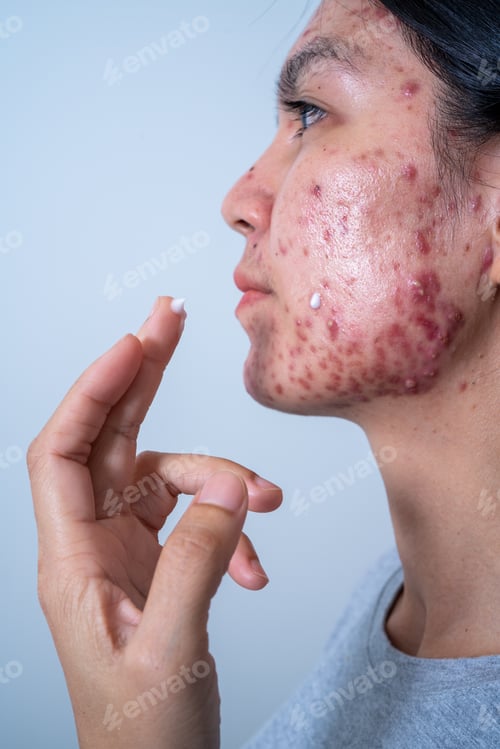 Preview: Acne on face because the disorders of sebaceous glands productions. Acne or a Cosmetic Allergy.