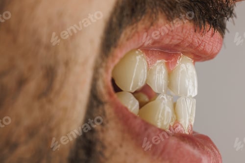 Preview: Close Up Of A Teeth Of A Young Man While Preparing For Orthodontist