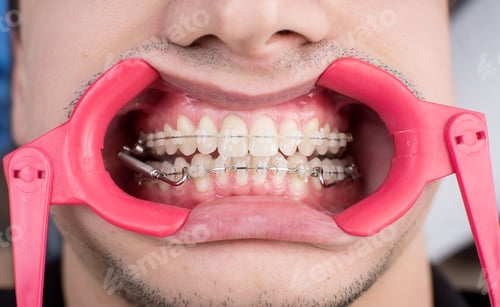 Preview: Macro shot of white teeth with braces and dental retractor at the dental office