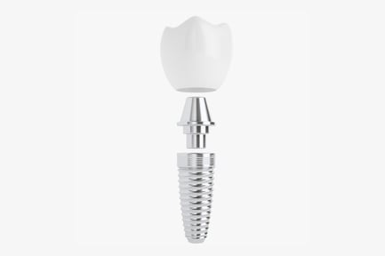 Preview: Dental Implant Assembly with Crown
