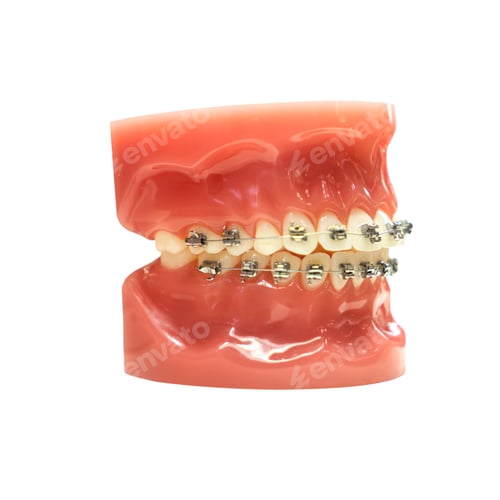 Preview: tooth model with metal wire dental braces isolated on white background