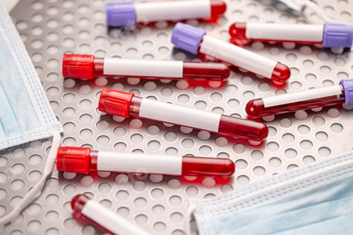 Preview: Test tubes with blood samples