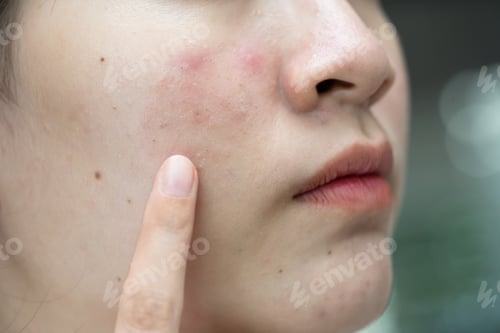 Preview: Asian young with pimple, acne, scar on skin, facial problem.