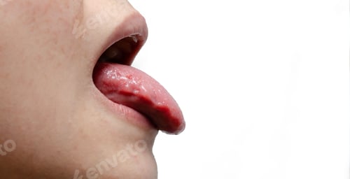 Preview: Tongue of a young Caucasian woman with benign migratory glossitis, candidiasis.