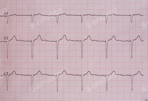 Preview: Electrocardiogram graph printed on paper.