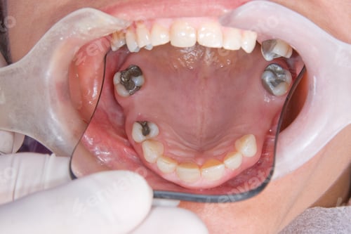 Preview: oral rehabilitation process, partial removable prosthesis