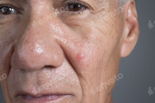 Preview: Man with a big ugly pimple on his cheek