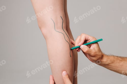Preview: Woman recovering from DVT, surgeon draws lines on leg veins for surgical guidance