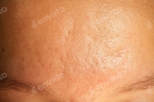 Preview: post-acne, scars and red festering pimples on the face of a young woman.