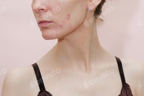 Preview: Woman With Problem Skin. Teen Acne On Young Skin.