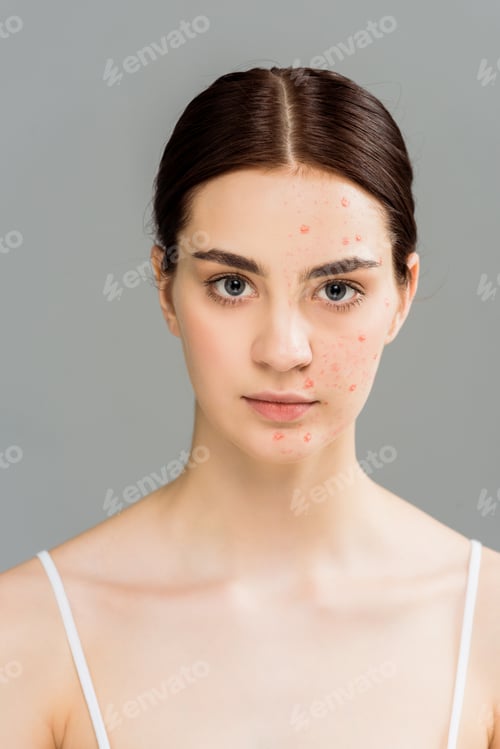 Preview: woman with acne on face looking at camera isolated on grey