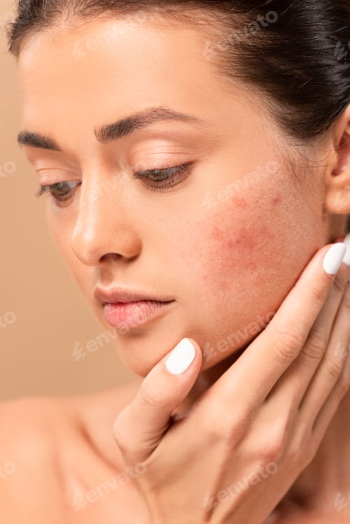 Preview: naked girl touching face with problem skin isolated on beige