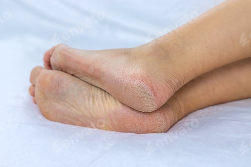Preview: Female feet dry skin on the heels. Selective focus.