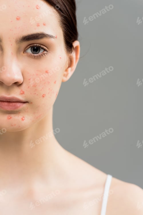 Preview: cropped view of young woman with acne looking at camera isolated on grey