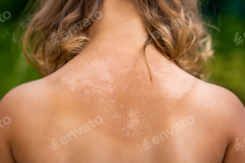 Preview: The skin is very peeling after sunbathing, the tanned back of a little girl. Sunburn concept