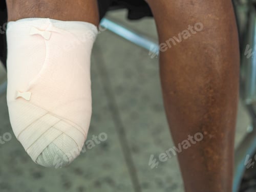 Preview: Elastic bandaged below knee amputation