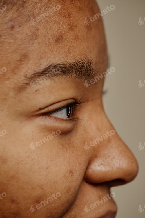 Preview: Macro shot side view of ethnic young woman with acne scars on face minimal