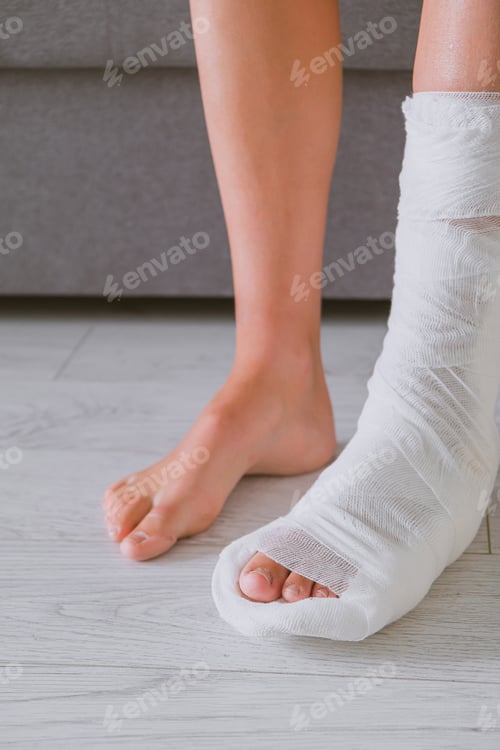 Preview: Leg injury, ankle fixation, cast. woman with a leg injury sits on the couch. Rehabilitation at home