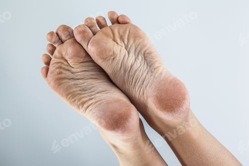 Preview: dehydrated skin female heels