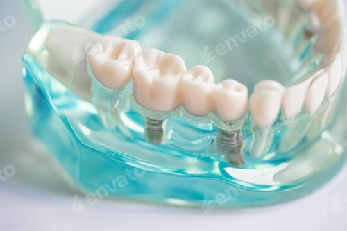 Preview: Dental implant, artificial tooth roots into jaw, root canal of dental treatment, gum disease
